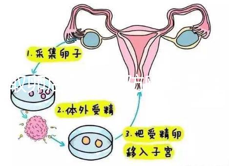 取卵后怎么預防卵巢囊腫？5種科學方法值得學習