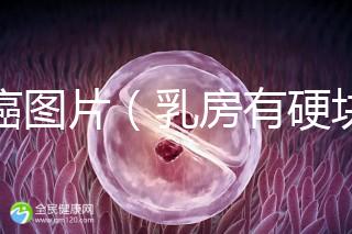 乳癌圖片（乳房有硬塊的位置圖片）