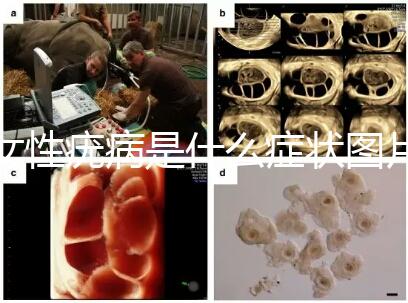 女性疣病是什么癥狀圖片(女生下面長(zhǎng)了疙瘩圖片)