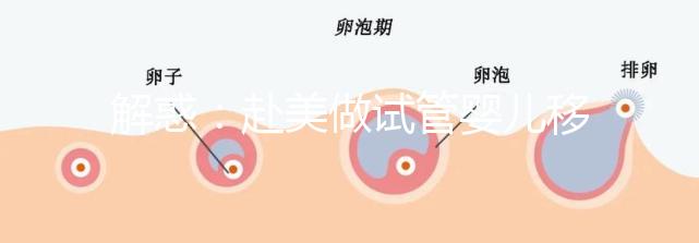 解惑：赴美做試管嬰兒移植兩個囊胚-生雙胞胎的概率